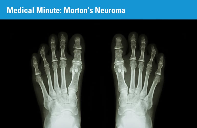 Medical Minute: Morton’s Neuroma