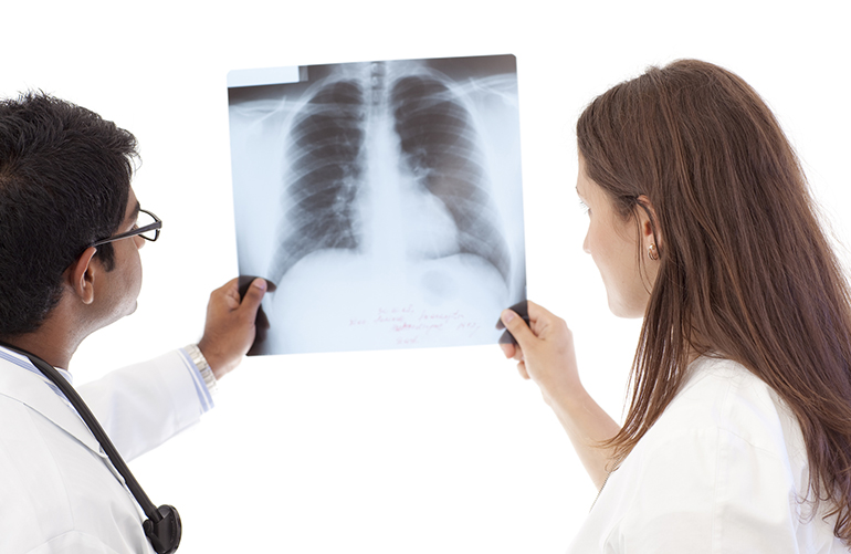 Should You Get a Lung Cancer Screening?