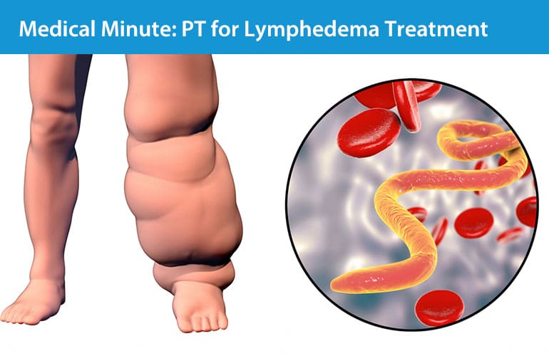 Medical Minute: Physical Therapy for the Treatment of Lymphedema