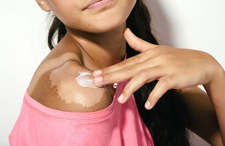 Medical Mythbuster: Does Peeling a Sunburn Makes it Heal Faster?