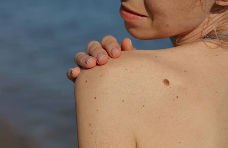 Concerned Your Mole Could Be Melanoma?
