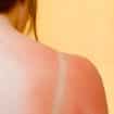 Tips for Caring for a Sunburn