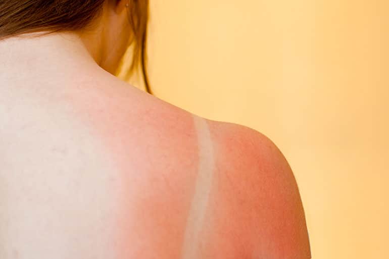 Tips for Caring for a Sunburn