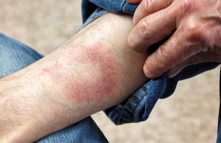 Symptom of Lyme Disease, Circular Expanding Rash, Erythema Migra