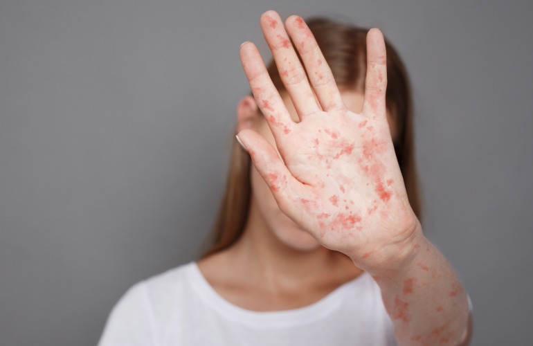 Learn More About the Risk of Measles