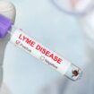 Lyme Disease: Here’s What You Need to Know