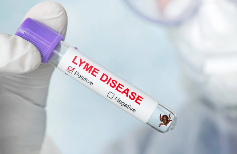 Lyme Disease: Here’s What You Need to Know